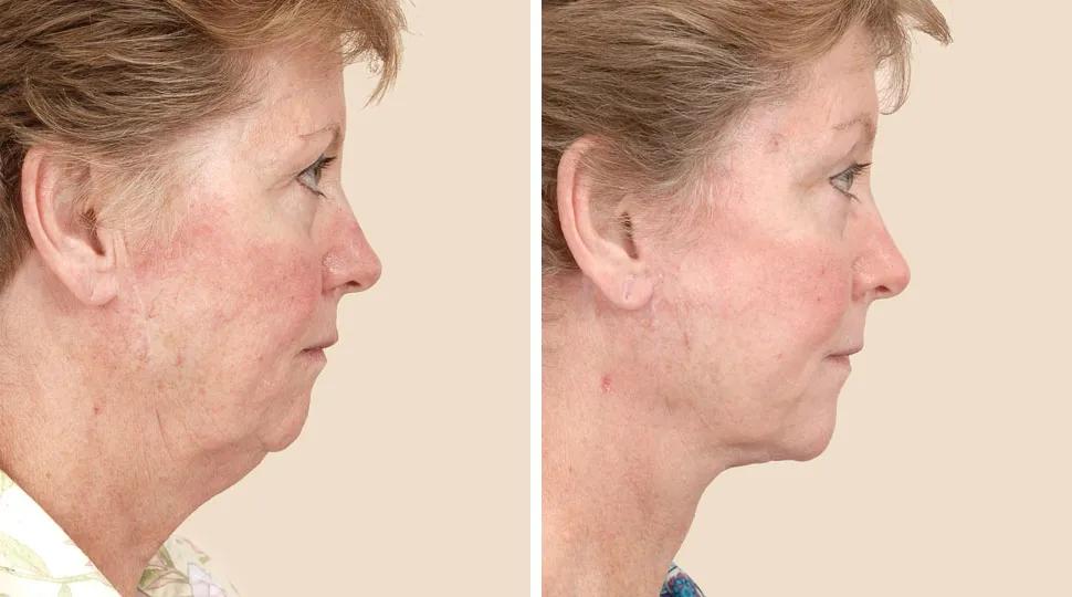 Facelift before & after photo
