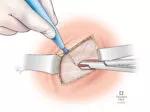 B. Division of anterior rectus sheath