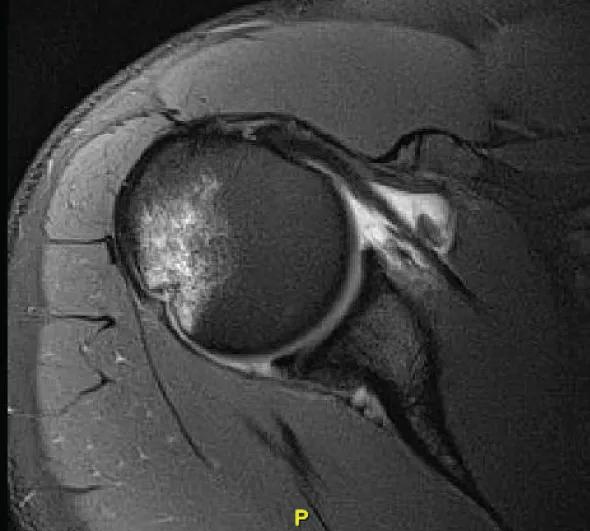Figure 1. Axial cut from an MRI demonstrating an anterior labral tear and posterior bruising of the humerus.