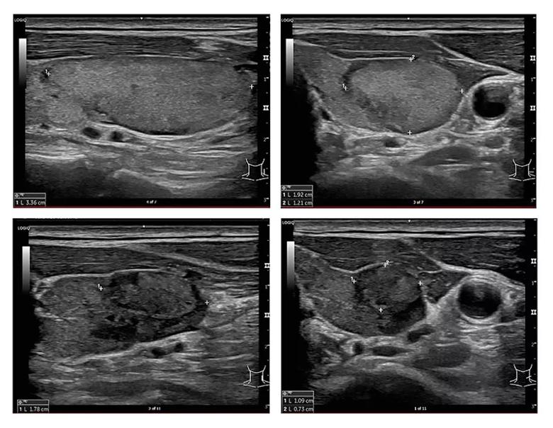 Images of treated thyroid nodules over time.