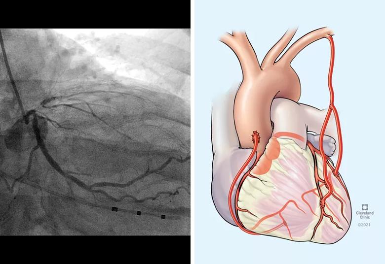 images showing multivessel coronary disease and its surgical repair