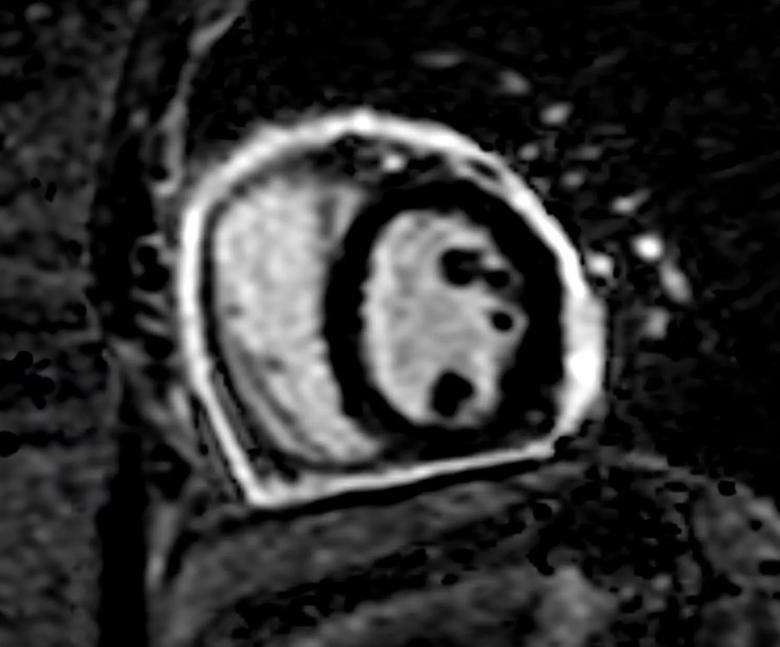 severe pericardial inflammation on cardiac MRI