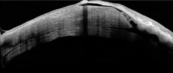 Figure 2: One week postoperative OCT shows partially attached DSEK graft. Note the extremely thin connection between healthy cornea and the thinned peripheral cornea. A fluid tract is allowing aqueous to create a bleb at the top of the image.
