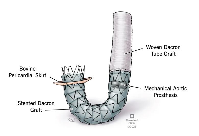 Illustration of extra-anatomical valved conduit 