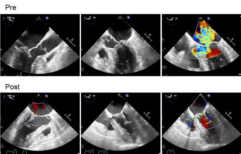 Hypertrophic obstructive cardiomyopathy