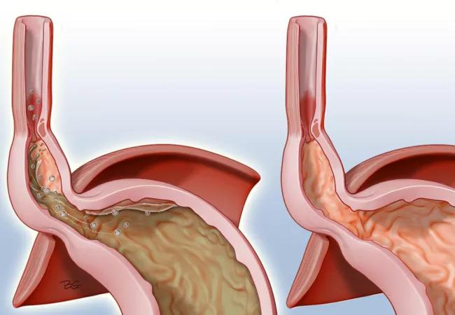 Esophageal Length Predicts Which Patients with Hiatal Hernia Need More  Invasive Surgery to Prevent Hernia Recurrence