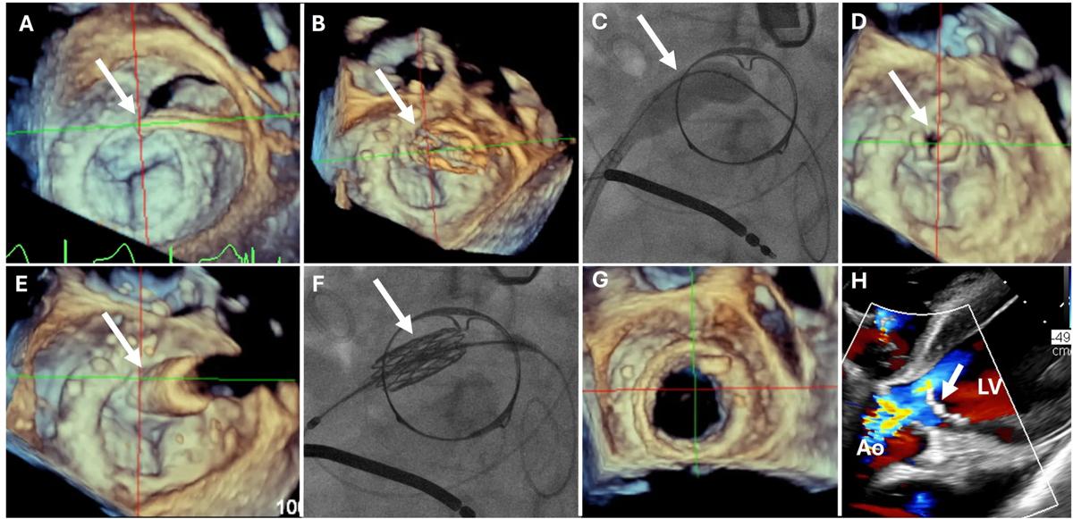 eight panels of echocardiograms and angiograms from a heart valve procedure