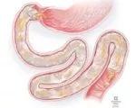 Duodenal liner