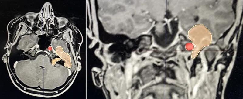 MRIs of the head showing a tumor