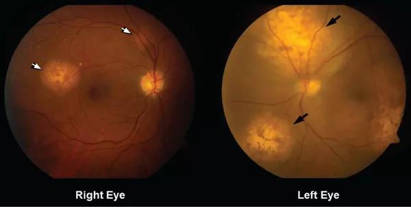 Funduscopy showed multiple lobulated, yellowish choroidal lesions in the posterior pole, with overlying subretinal fluid.