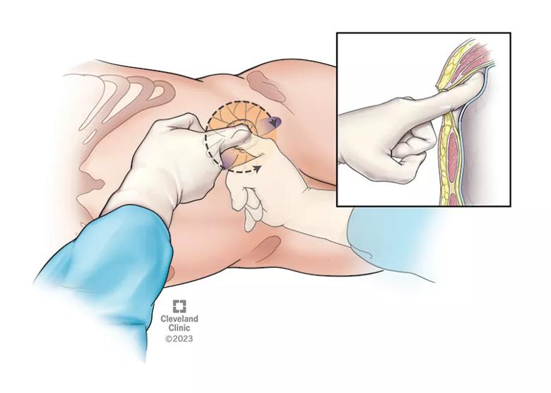 Drawing of surgeon's fingers pressing into a patient's body