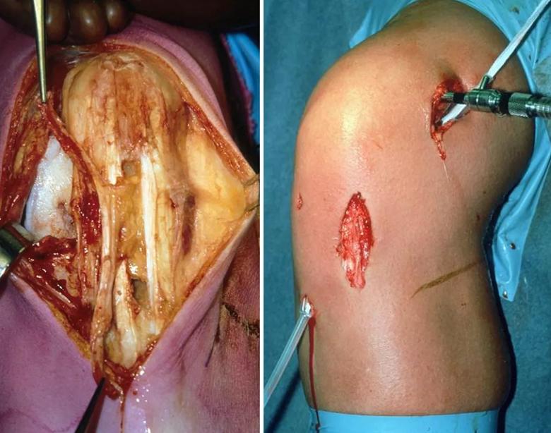 Patellar tendon harvesting procedures