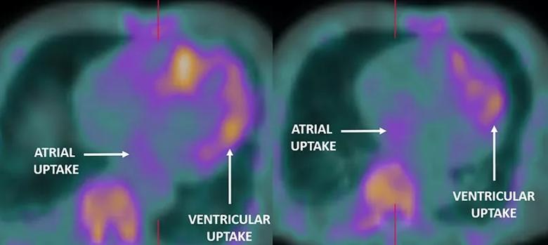 cardiac scintigraphy image