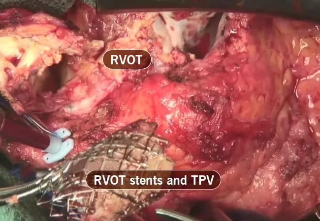 intraoperative photo from a congenital heart surgery