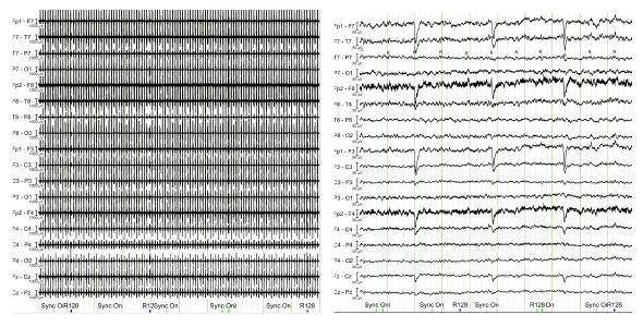 Raw EEG data acquired in a 3T Siemens MRI scanner before artifact removal. EEG data after artifact removal showing normal brain activity during wakefulness along with eye movement potentials, which are distributed, as expected, over the most anterior frontal EEG electrodes.