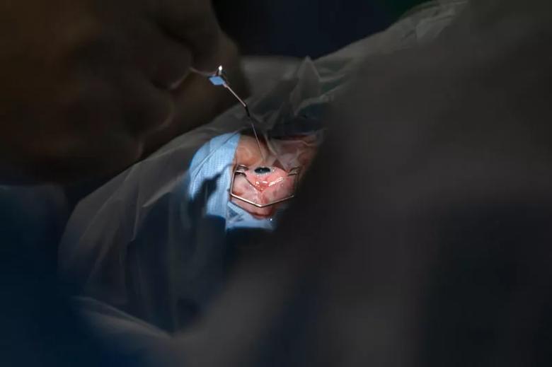 The eye of a patient prepared for surgery