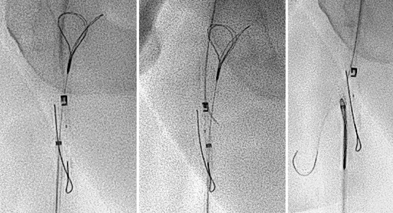 alignment of crossing device in endovascular procedure