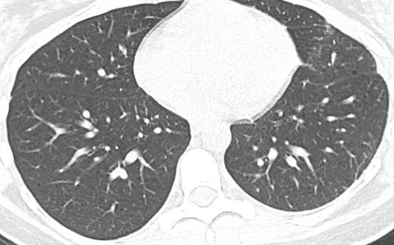 Biopsy showing Lymphangioleiomyomatosis 