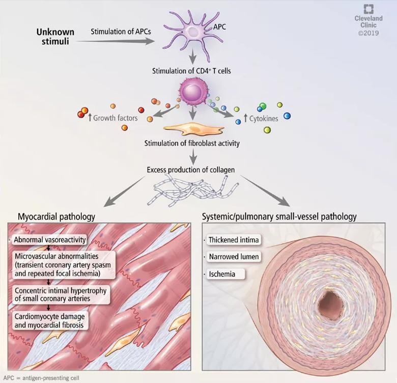 mechanisms of cardiac and vascular involvement in systemic sclerosis