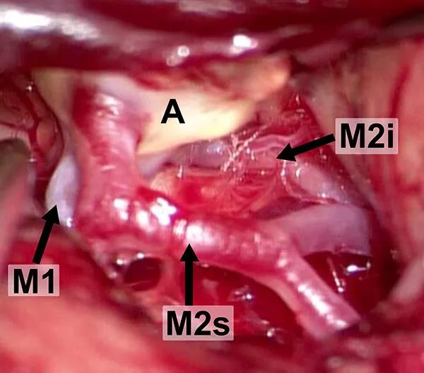 Intraoperative microscopic view of the MCA bifurcation seen through the Sylvian fissure.