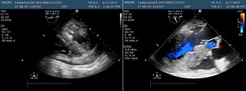 Figure 1. TEE findings showing a large pericardial effusion.