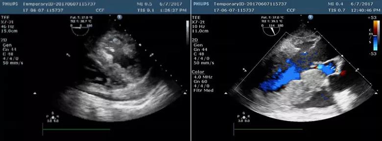 Figure 1. TEE findings showing a large pericardial effusion.