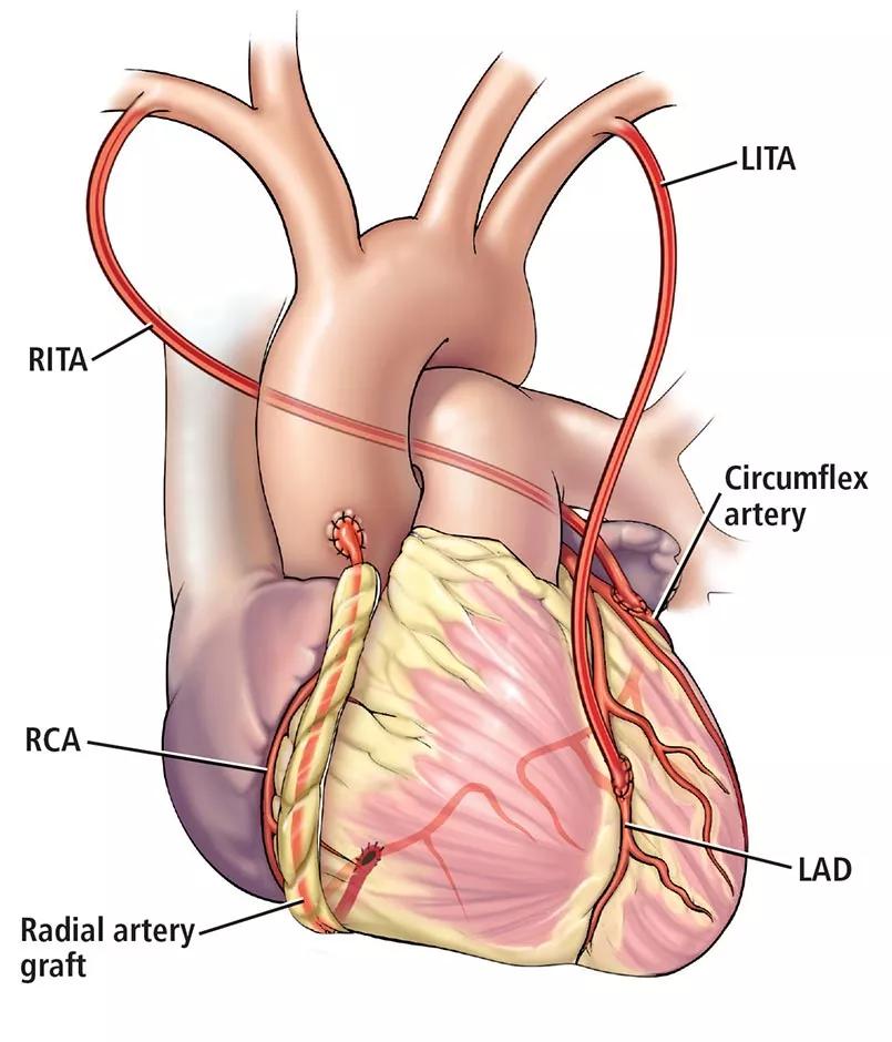 Medical illustration of a multiarterial CABG.