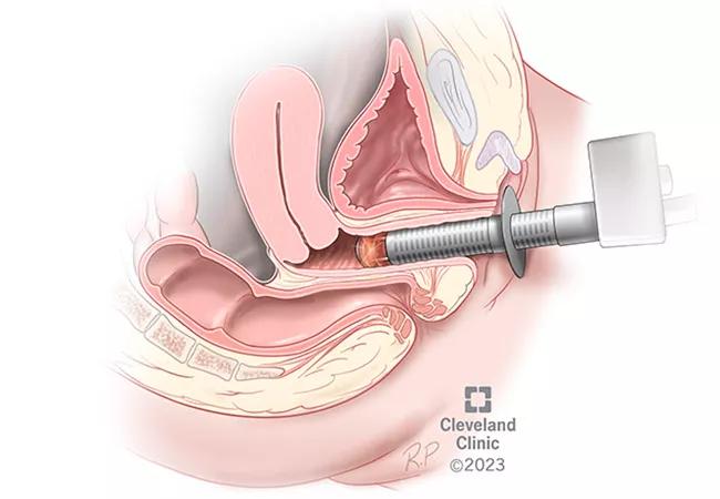 Energy-Based Device Holds Promise for Patients with Vaginal Atrophy