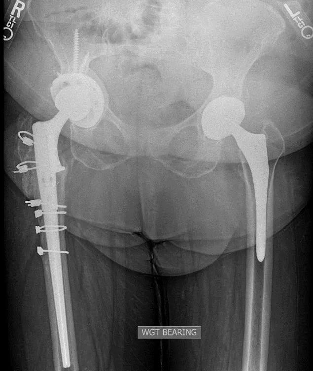 X-ray of hip replacement