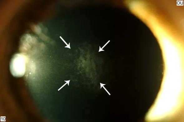 eye corneal scarring