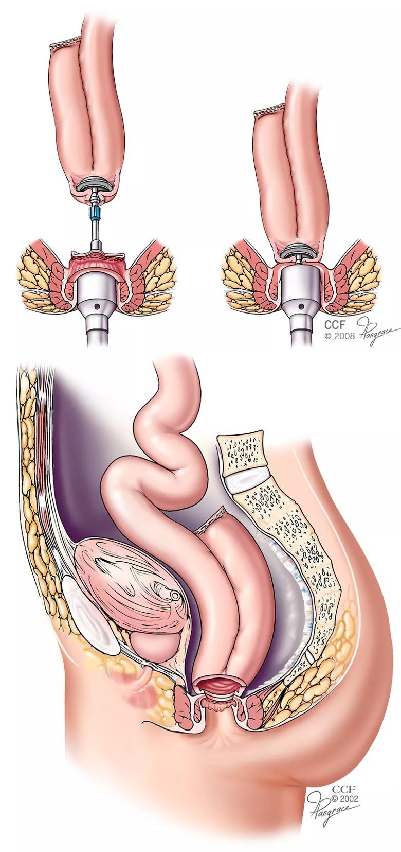 Long-Term Follow-Up of Ileal Pouch Anal Anastomosis in Pediatric and Young  Adult Patients with Ulcerative Colitis