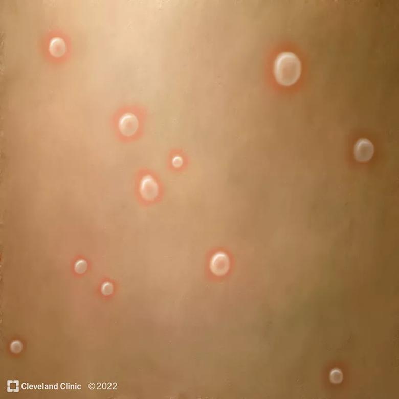 Progression of monkeypox rash