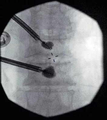 Images showing T7 and T8 kyphoplasty in a patient with multiple myeloma 