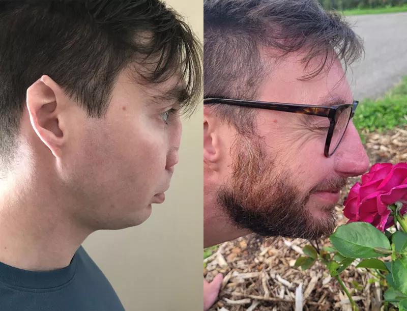Before and after images of patient