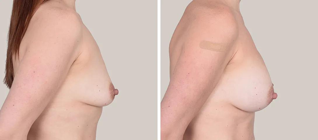 Breast augmentation before & after photo