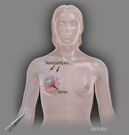 Figure-01_Breast-CA-NanoParticles-500