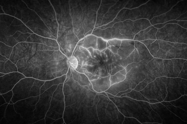 Retinal artery occlusion on angiography