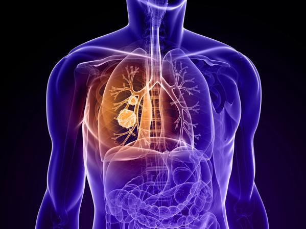 Diagram of a torso showing site of cancer in the lung