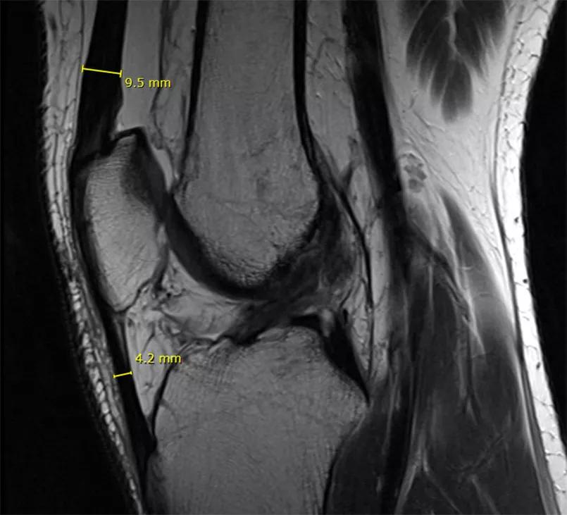 MRI