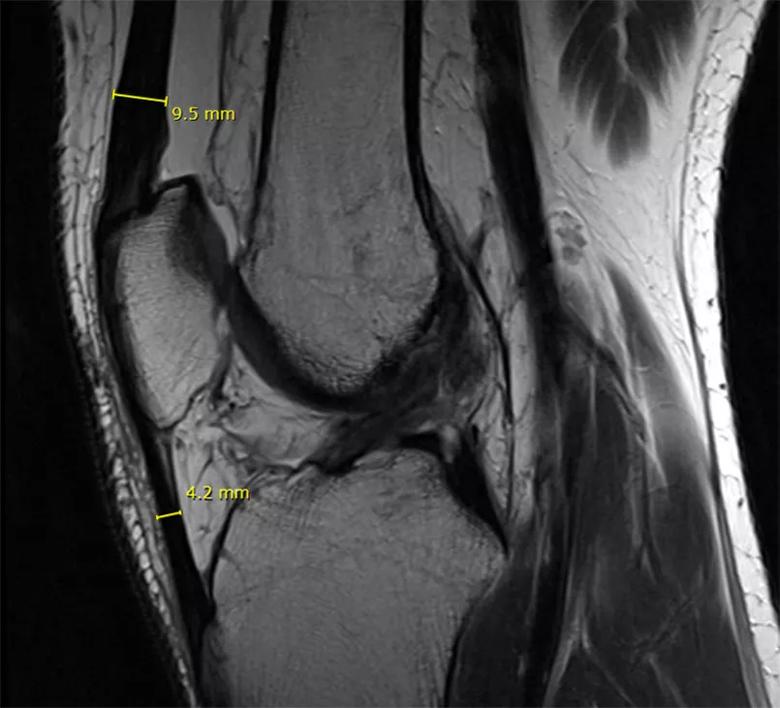 MRI