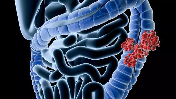 Cleveland-Clinic-Colorectal-Cancer