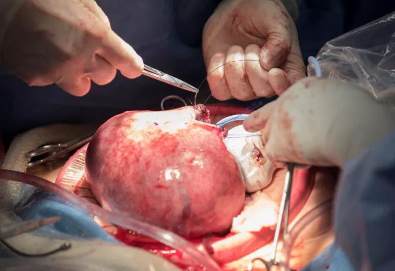 Placing sutures to secure the membranes and myometrium at the start of the hysterotomy. 