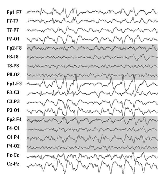 Schematic illustration of an EEG spike predominantly involving EEG electrodes recording from the left frontal and central regions of the patient’s brain. During simultaneously recorded EEG/fMRI, correlation is sought between the time of EEG spike and the brain activation pattern.