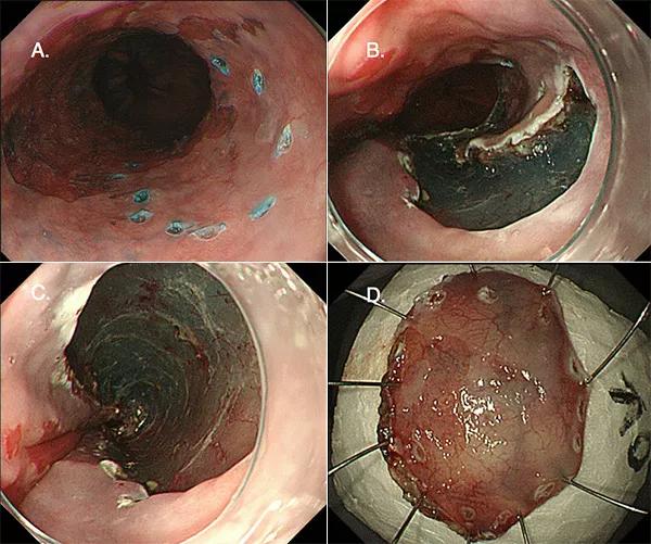 SubmucosalDissection-Inset
