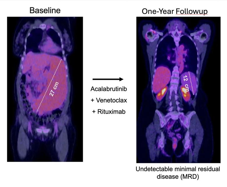 Before & after PET scans
