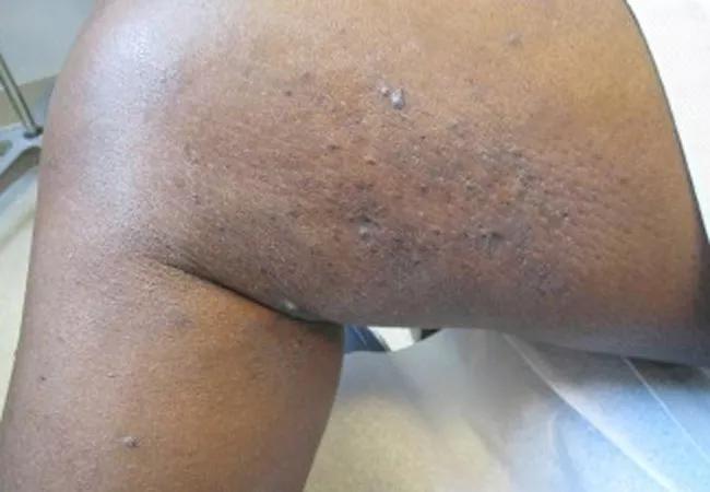 Kaposi sarcoma