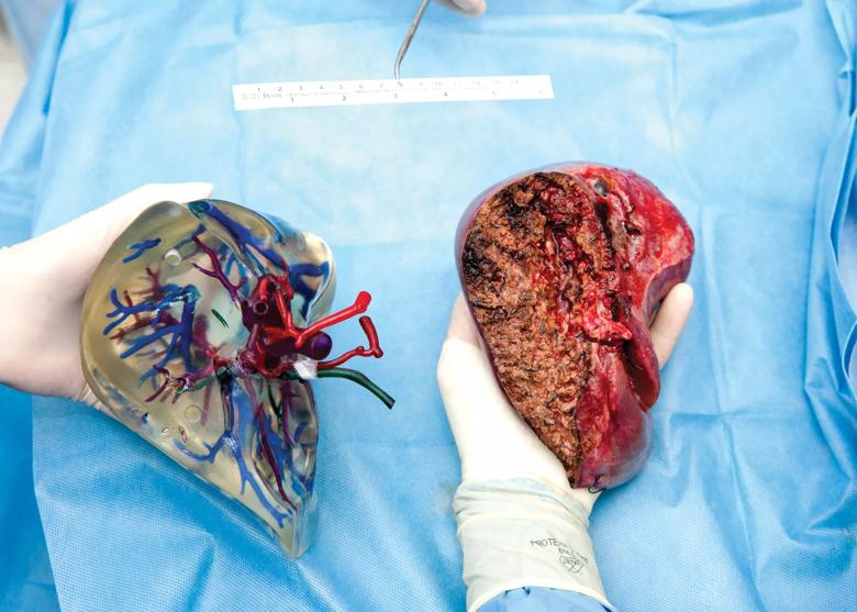Live Donor Liver Transplant, Model & both Donor & Expalnt Liver only, taken on 07-08-13 in Operating rooms # 28 & #29 and in surgical Pathology taken for Drs. Zein,Hanouneh,Samaan & Ryan Klatte