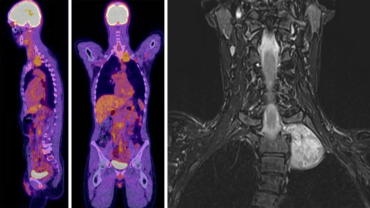 7 cm schwannoma at the intersection of the spine, lung and major arteries
