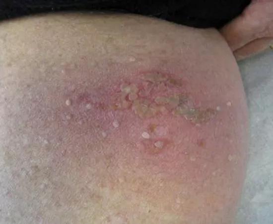 Skin complication