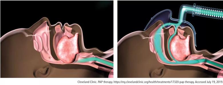 Obstructed airway is opened with a column of air delivered using positive airway pressure therapy.